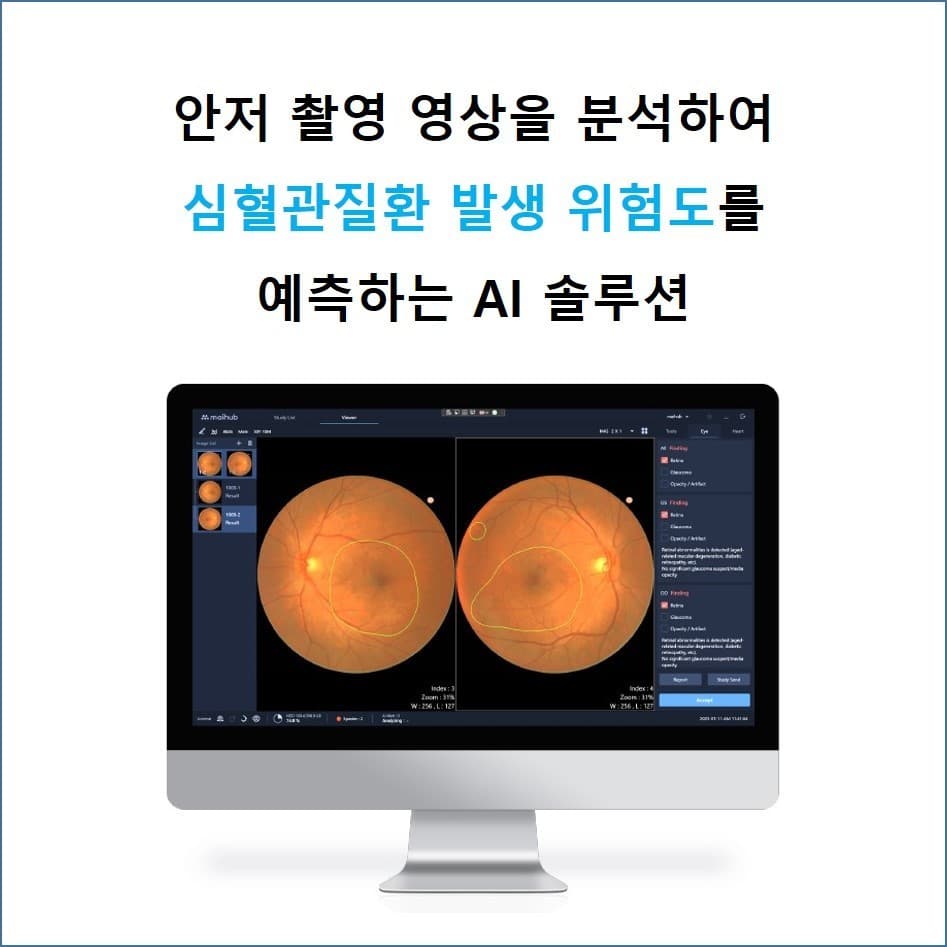 안과질환 진단 및 심혈관질환 발생 위험도 예측 AI 솔루션